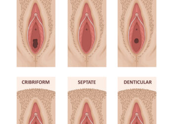 Mikroperforuota mergystės plėvė: priežastys, simptomai ir gydymas
