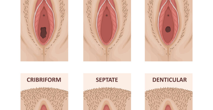 Mikroperforuota mergystės plėvė: priežastys, simptomai ir gydymas