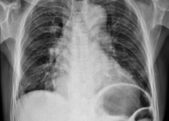 Kairiojo prieširdžio padidėjimas (KPP): simptomai, priežastys ir gydymas