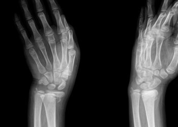 Kienböcko liga: simptomai, priežastys ir gydymas