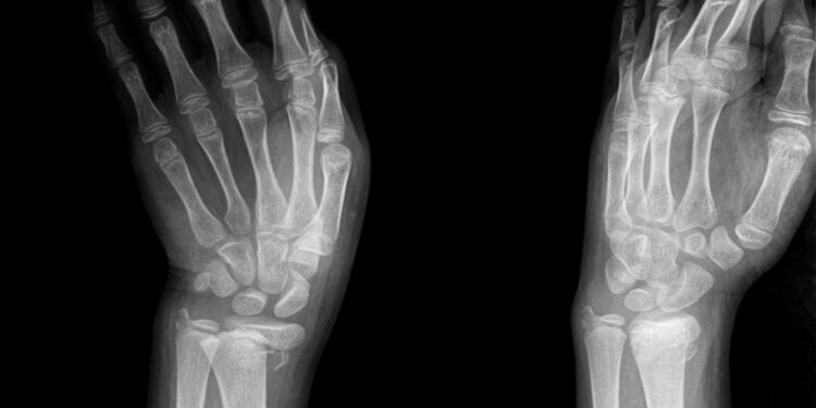 Kienböcko liga: simptomai, priežastys ir gydymas