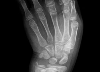 Maffucci sindromas: kremzlės dariniai (enchondromos) ir audinių peraugimas