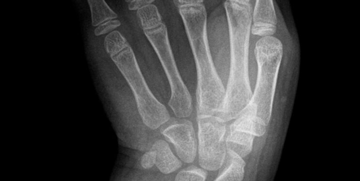 Maffucci sindromas: kremzlės dariniai (enchondromos) ir audinių peraugimas