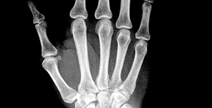 Meloreostozė: simptomai, priežastys ir gydymas