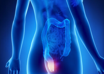 Hemorojaus gydymas, simptomai, priežastys ir profilaktika