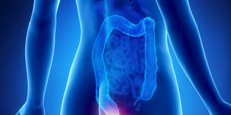 Hemorojaus gydymas, simptomai, priežastys ir profilaktika
