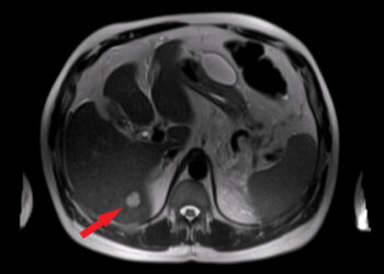 Kepenų cistos: simptomai, priežastys, tipai ir gydymas