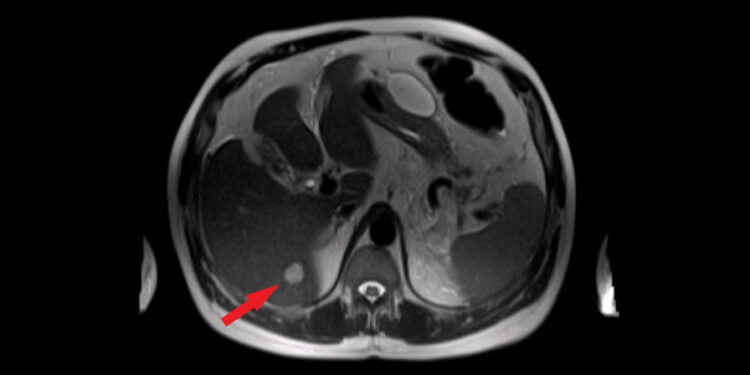 Kepenų cistos: simptomai, priežastys, tipai ir gydymas