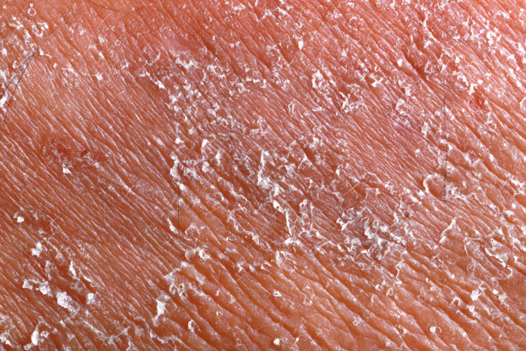Sjogreno sindromas
