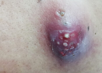 Žmogaus histiocitoma: tipai, priežastys, simptomai, gydymas ir prognozė