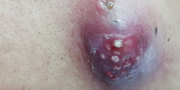 Žmogaus histiocitoma: tipai, priežastys, simptomai, gydymas ir prognozė