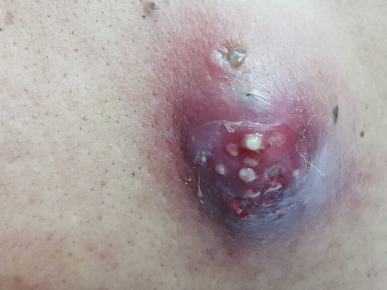 Žmogaus histiocitoma: tipai, priežastys, simptomai, gydymas ir prognozė