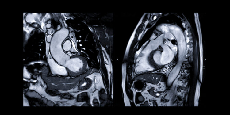Aortos perkryžavimas: simptomai, priežastys ir gydymas