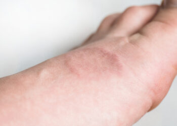 Granulioma anulė: simptomai, priežastys ir gydymas