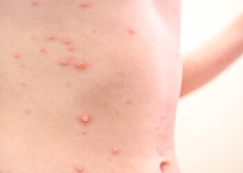 Raupai: Priežastys, simptomai, gydymas ir prevencija