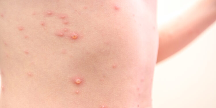 Raupai: Priežastys, simptomai, gydymas ir prevencija