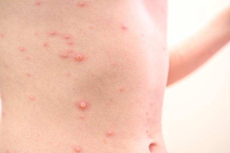 Raupai: Priežastys, simptomai, gydymas ir prevencija