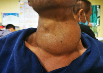 Medulinis skydliaukės vėžys: kas tai, simptomai ir gydymas