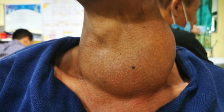 Medulinis skydliaukės vėžys: kas tai, simptomai ir gydymas