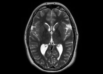 Leigh sindromas (Leigh liga): priežastys ir simptomai