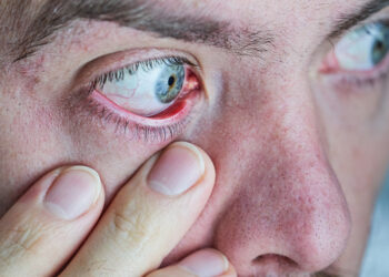 Keratitas: rūšys, simptomai ir gydymas