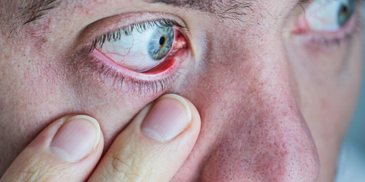 Keratitas: rūšys, simptomai ir gydymas