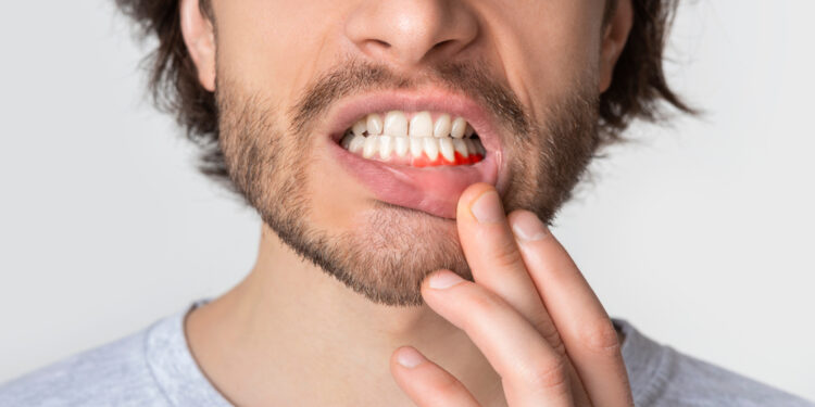 Perikoronitas: simptomai, priežastys ir gydymas