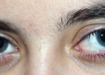 Exotropija: tipai, simptomai, priežastys ir gydymas