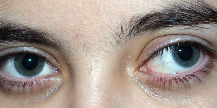 Exotropija: tipai, simptomai, priežastys ir gydymas