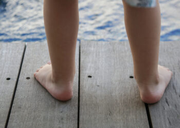 Perdėtas pėdos pronavimas: kas tai, priežastys ir gydymas