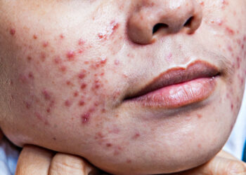 Cistinė aknė ant nugaros