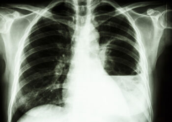 Melioidozė: priežastys, simptomai, plitimas ir gydymas