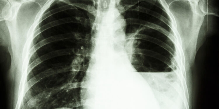 Melioidozė: priežastys, simptomai, plitimas ir gydymas