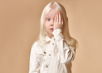 Akių albinizmas: kas tai, priežastys, simptomai ir prognozė