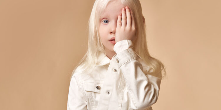 Akių albinizmas: kas tai, priežastys, simptomai ir prognozė