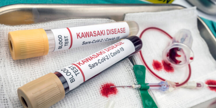 Kavasakio liga: simptomai, priežastys ir gydymas