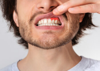 Dantenų uždegimas: simptomai ir gydymo būdai