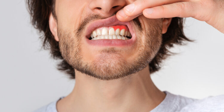 Dantenų uždegimas: simptomai ir gydymo būdai