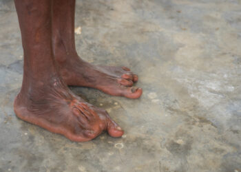 PHACE sindromas: simptomai ir gydymas