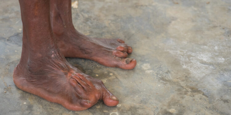 PHACE sindromas: simptomai ir gydymas