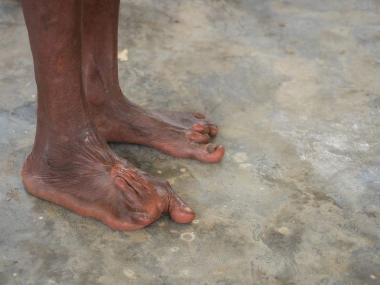 PHACE sindromas: simptomai ir gydymas