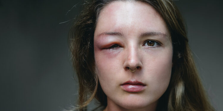 Periorbitalinis (preseptalinis) celulitas: gydymas