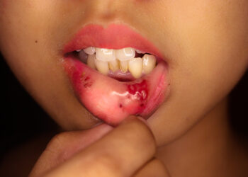 Jaunatvinė polipozė: priežastys, simptomai ir gydymas