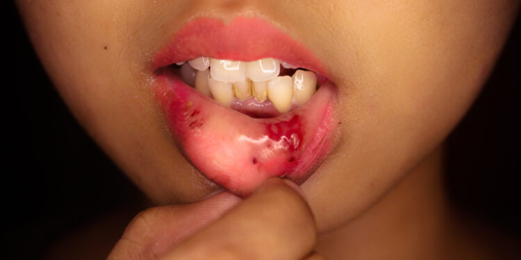 Jaunatvinė polipozė: priežastys, simptomai ir gydymas