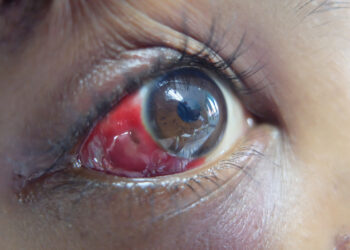 Loiazė (Afrikinis akių kirminas): priežastys ir gydymas