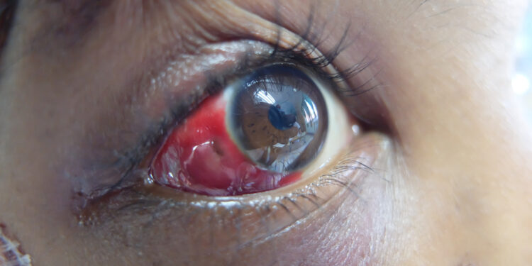 Loiazė (Afrikinis akių kirminas): priežastys ir gydymas