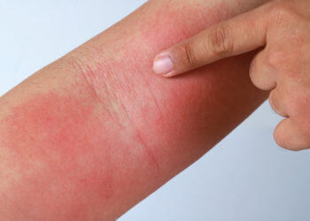 Kaip progresuoja egzema?