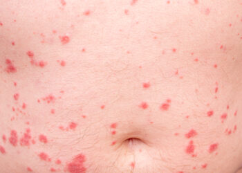 Lašelinė psoriazė: simptomai, priežastys ir gydymas