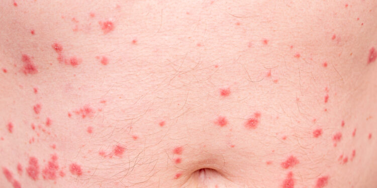 Lašelinė psoriazė: simptomai, priežastys ir gydymas
