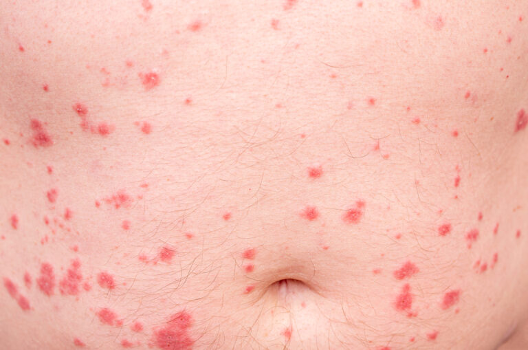Lašelinė psoriazė: simptomai, priežastys ir gydymas